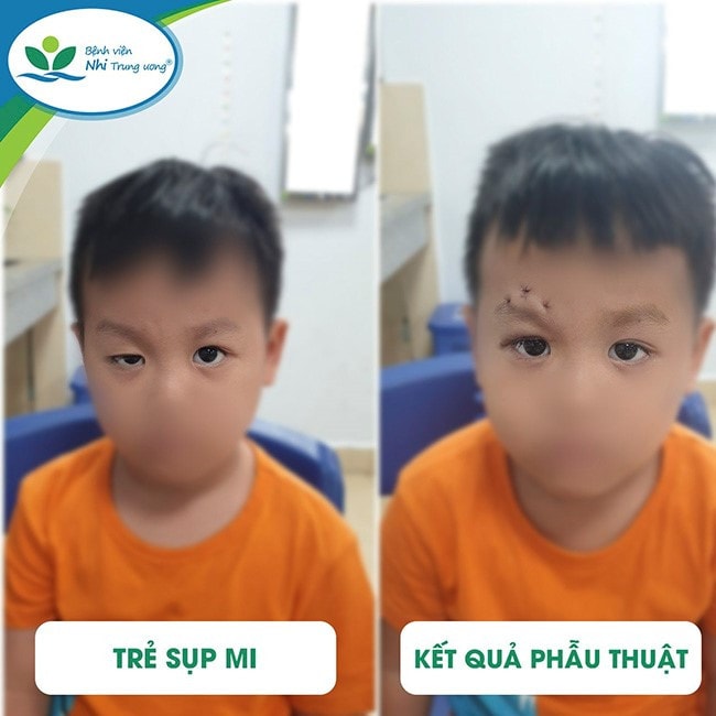 Sụp mi ở trẻ em có thể là biểu hiện của bệnh lý nguy hiểm, bác sĩ khuyến cáo -0
