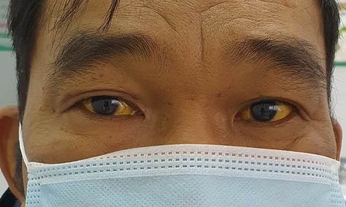 Người đàn ông bị hỏng gan nặng do lạm dụng thuốc nam -0
