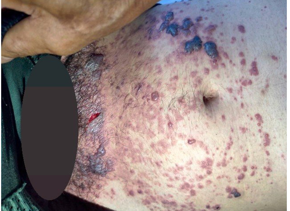 Cảnh báo bệnh thuỷ đậu nhập viện tăng, đã có 2 trường hợp tử vong -0
