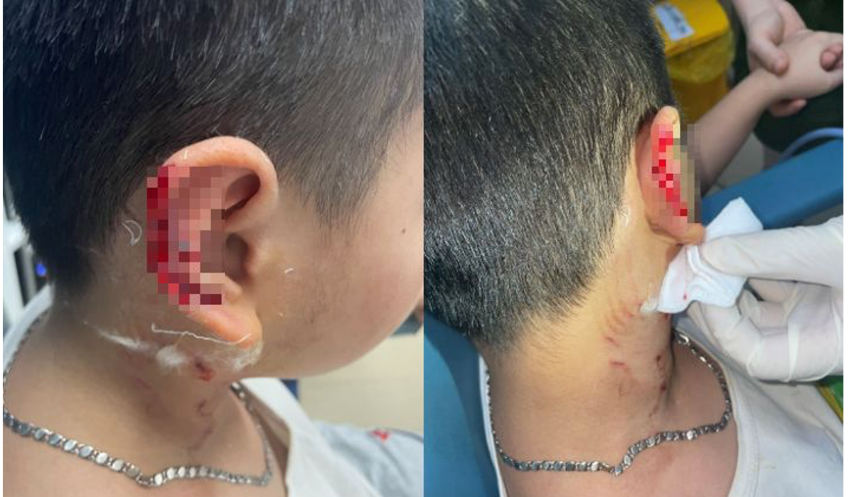 Trẻ tổn thương mặt, rách tai vì bị chó cắn: Bác sĩ chỉ cách sơ cứu -0
