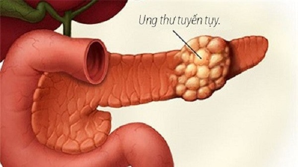 Các triệu chứng báo hiệu bạn bị ung thư tụy -0