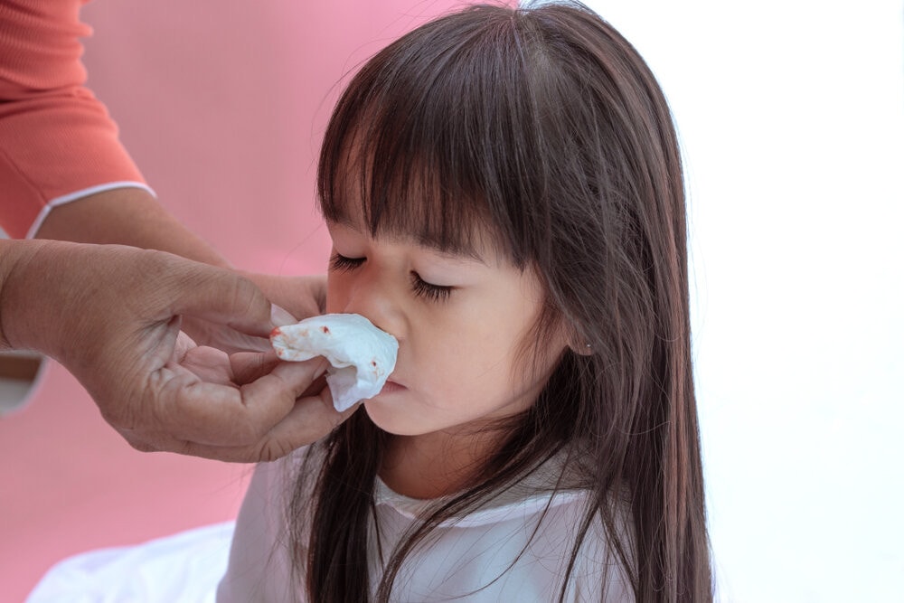 Bác sĩ hướng dẫn cha mẹ 5 bước xử trí đúng khi trẻ bị chảy máu cam -0