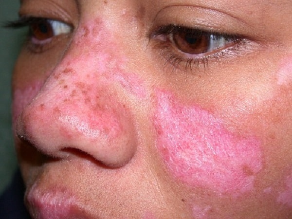 Bệnh Lupus ban đỏ hệ thống ảnh hưởng tới toàn cơ thể -0