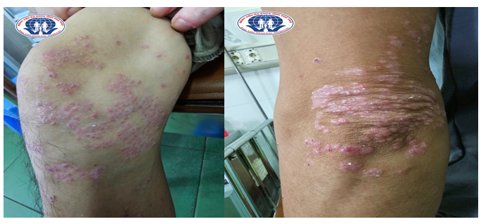 Bác sĩ cảnh báo những dấu hiệu nhận biết bệnh viêm khớp vảy nến -0