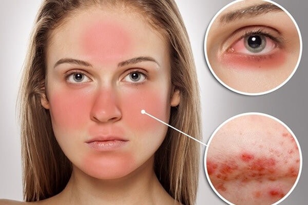 Bệnh Lupus ban đỏ phải mất vài năm mới chuẩn đoán chính xác ra bệnh -0