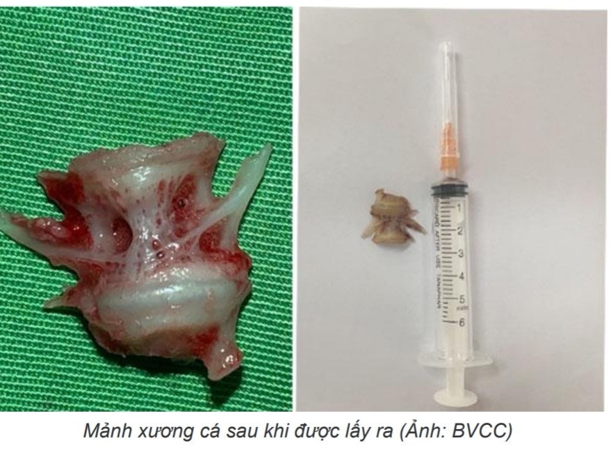 Người phụ nữ bị xương cá cắm sâu vào thực quản do ăn nhanh ảnh 1