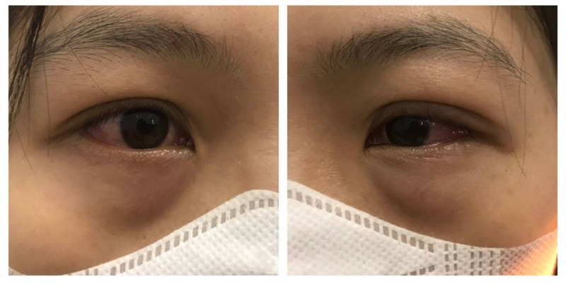 Cảnh báo dịch bệnh đau mắt đỏ gia tăng trong mùa hè -0