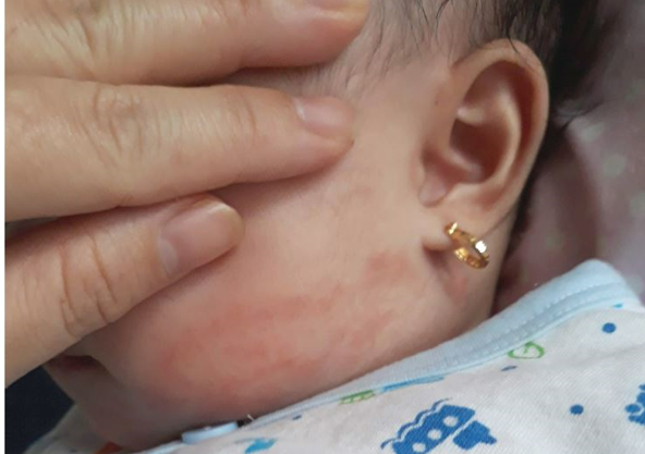 Những biện pháp phòng ngừa biến chứng bệnh viêm da cơ địa -0