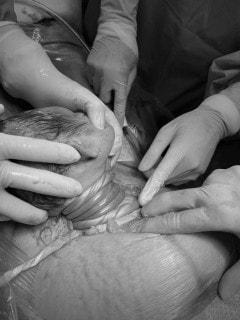 Bé sơ sinh bị nhau thai quấn cổ 5 vòng được cứu sống kịp thời -0