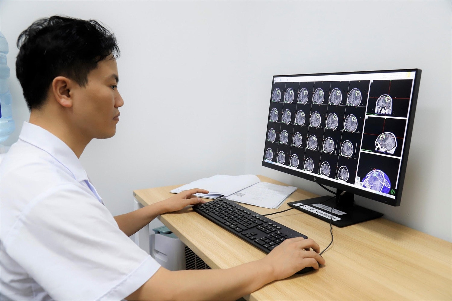 Sau 1 ngày điều trị khối u não chảy máu bằng xạ phẫu gamma, nam sinh đi học bình thường -0