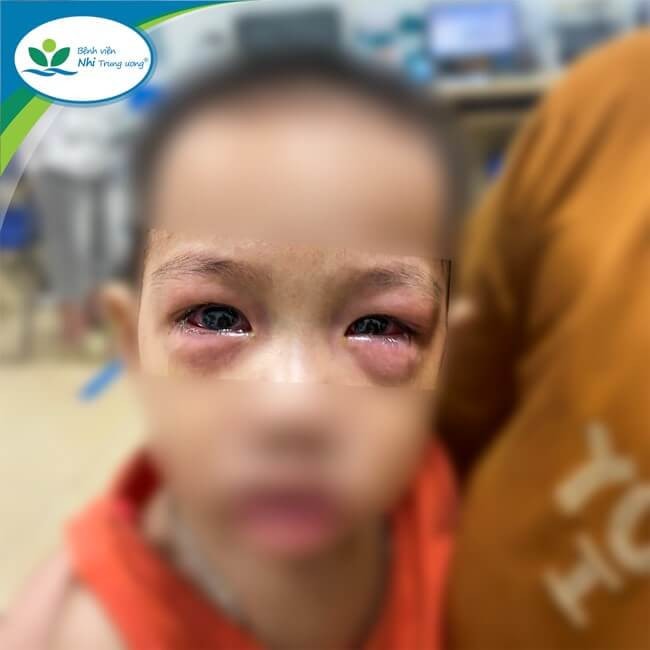 Bác sĩ khuyến cáo các biện pháp điều trị bệnh đau mắt đỏ -0