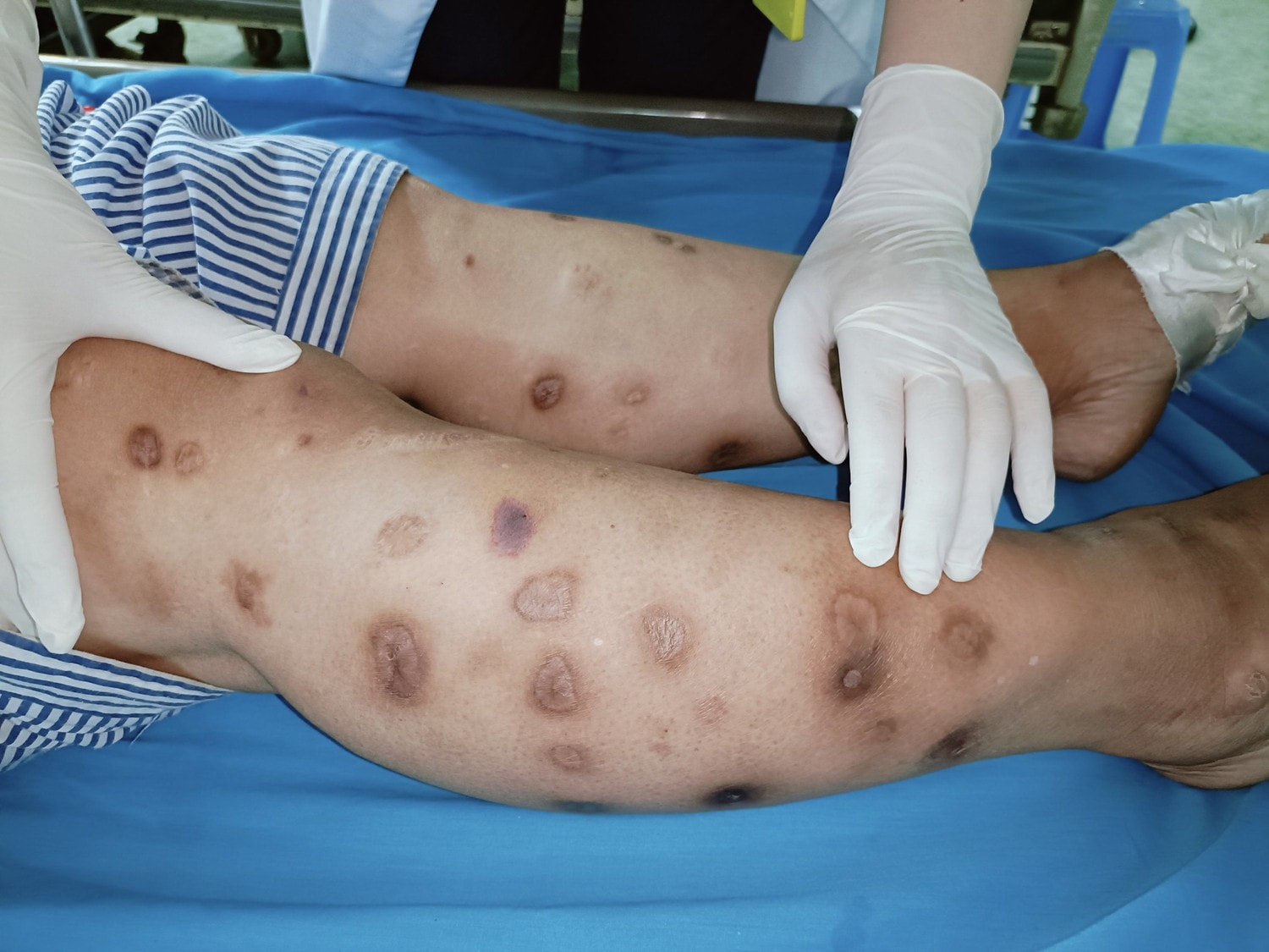 Nữ bệnh nhân rơi vào tình trạng nguy kịch sau khi tự tiêm Canxi -0