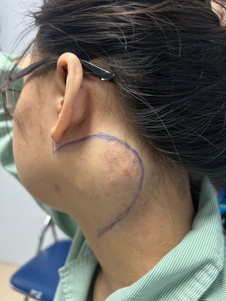 Nữ bệnh nhân lo sợ do khối u thần kinh ở vị trí nguy hiểm -0