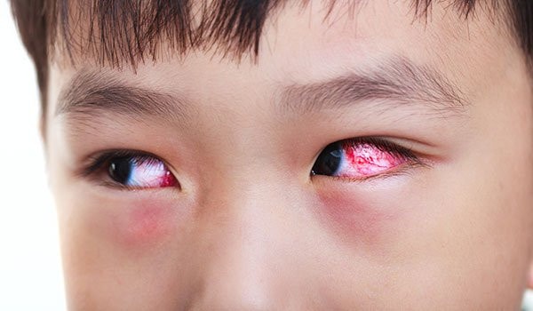 Bác sĩ hướng dẫn cách xử trí 6 “Không” cho người bệnh đau mắt đỏ -0