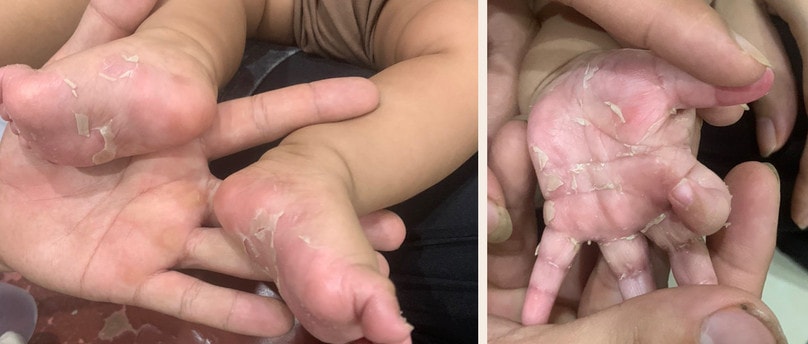 Bong tróc da ở tay chân, bé trai 3 tháng tuổi được chẩn đoán mắc bệnh giang mai bẩm sinh -0