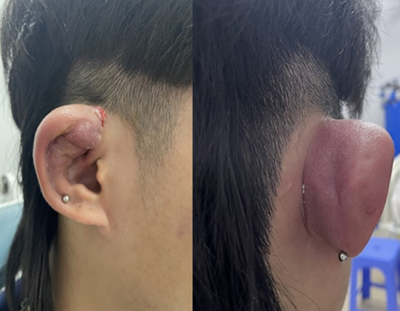 Bác sĩ cảnh báo hiểm họa từ việc xỏ lỗ tai -0