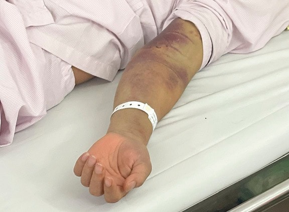 6 trường hợp tử vong do rối loạn đông máu và suy đa tạng từ bệnh sốt xuất huyết, Bác sĩ cảnh báo -0