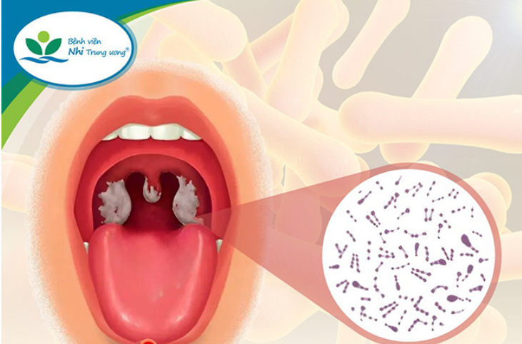 Bệnh bạch hầu: Các triệu chứng và cách phòng ngừa để tránh tử vong -0
