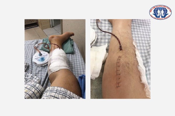 Nam bệnh nhân 32 tuổi suýt hoại tử chân do tự ý dùng thuốc Đông-Tây y kết hợp, Bác sĩ khuyến cáo -0