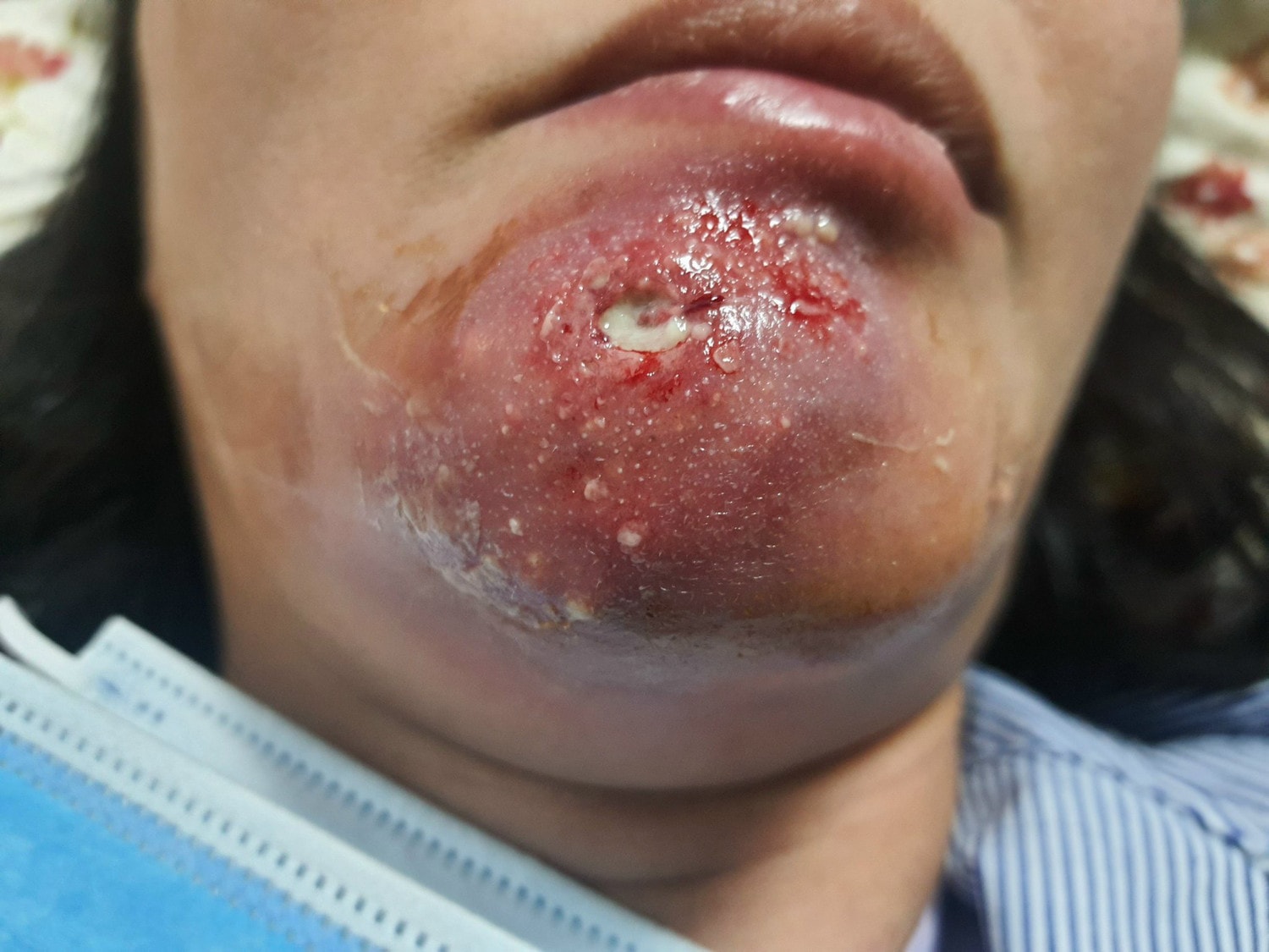 Dùng cao dán trị mụn, nữ bệnh nhân 48 tuổi nhiễm khuẩn tụ cầu vàng -0