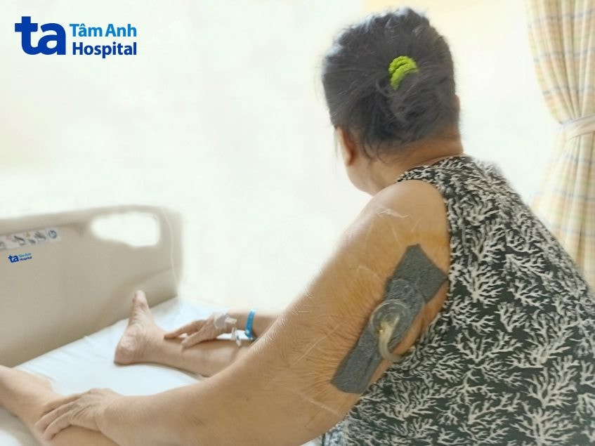 Bệnh nhân nữ 72 tuổi nhiễm trùng nặng do bấm huyệt để điều trị tiểu đường -0