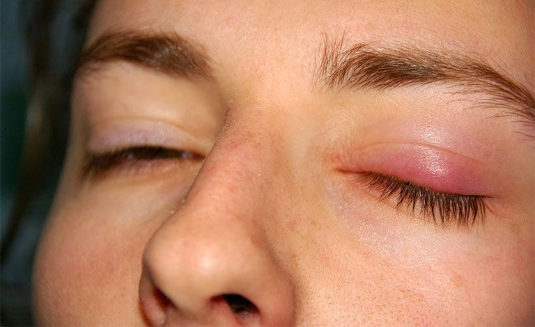 Sử dụng mỹ phẩm không rõ nguồn gốc, cô gái trẻ bị nhiễm trùng mi mắt -0