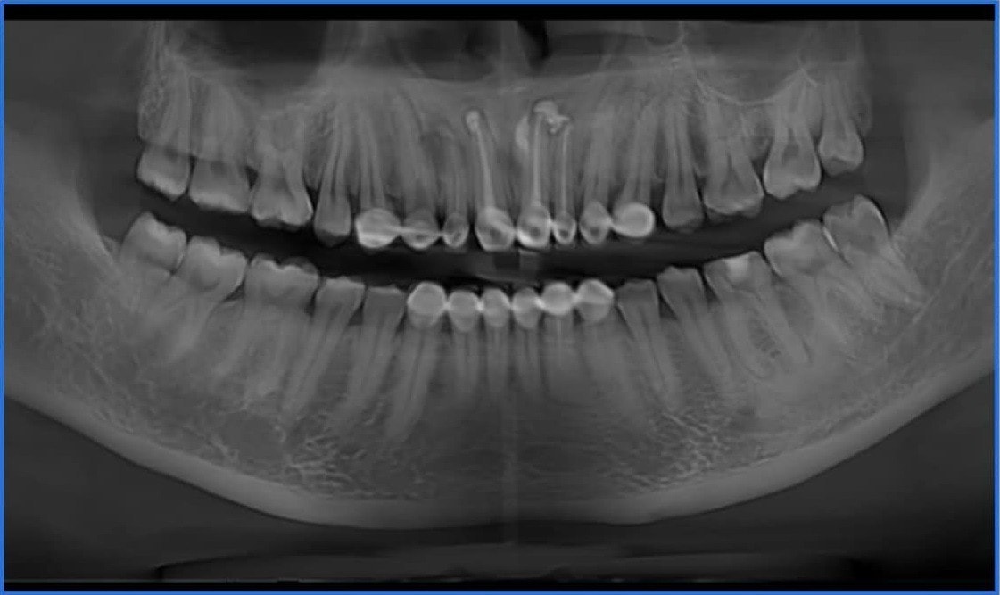 Nữ bệnh nhân 36 tuổi bị nang xương do bọc răng thẩm mỹ -0