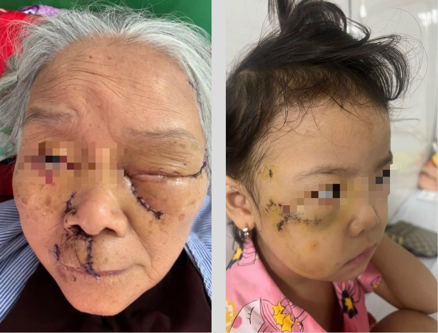 Liên tiếp xảy ra nhiều trường hợp chó cắn gây nguy hiểm cho tính mạng, Bác sĩ cảnh báo -0