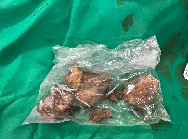 Ăn trái hồng ngâm, người phụ nữ trẻ bị tắc ruột non và dạ dày -0