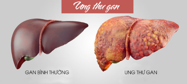 Những dấu hiệu nhận biết sớm của bệnh ung thư gan nguyên phát -0