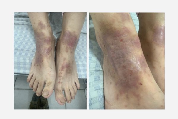 Nhiễm khuẩn do điều trị viêm da cơ địa bằng thuốc nam, Bác sĩ cảnh báo -0