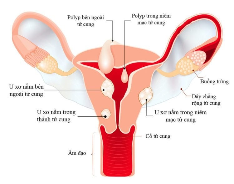 Tưởng béo bụng, người phụ nữ mang khối u “khủng” nặng 6 cân -0