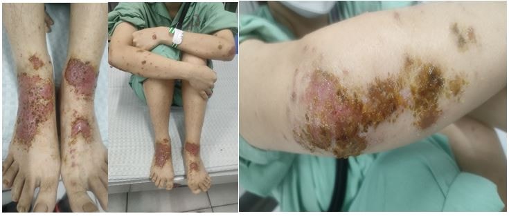 Nhiễm khuẩn do điều trị viêm da cơ địa bằng thuốc nam, Bác sĩ cảnh báo -0