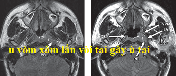 Tại sao bác sĩ khám tai mũi họng lại chỉ định đo thính lực - nhĩ lượng? -0