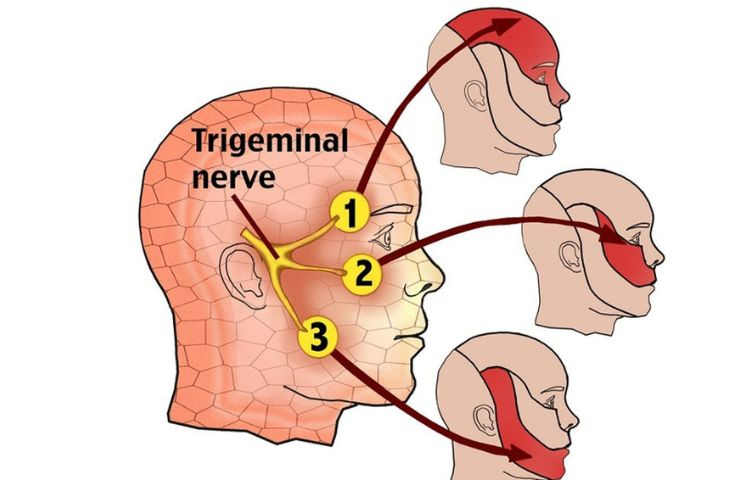 Nguyên nhân và triệu chứng của bệnh đau dây thần kinh số V -0