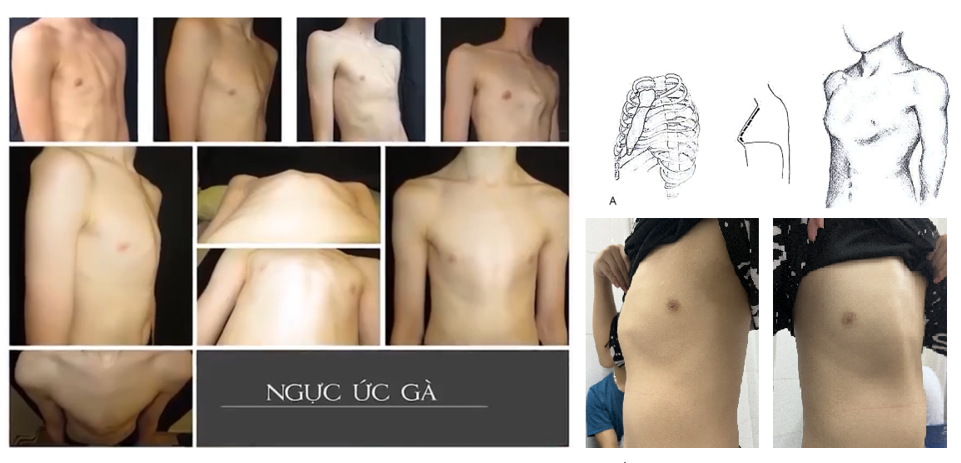 ngực-ức-gà-3.png -0