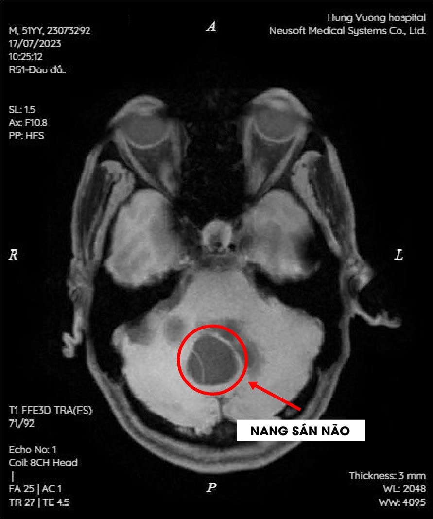 Từ thói quen ăn tiết canh, 2 bệnh nhân nhiễm nang sán trong não -0