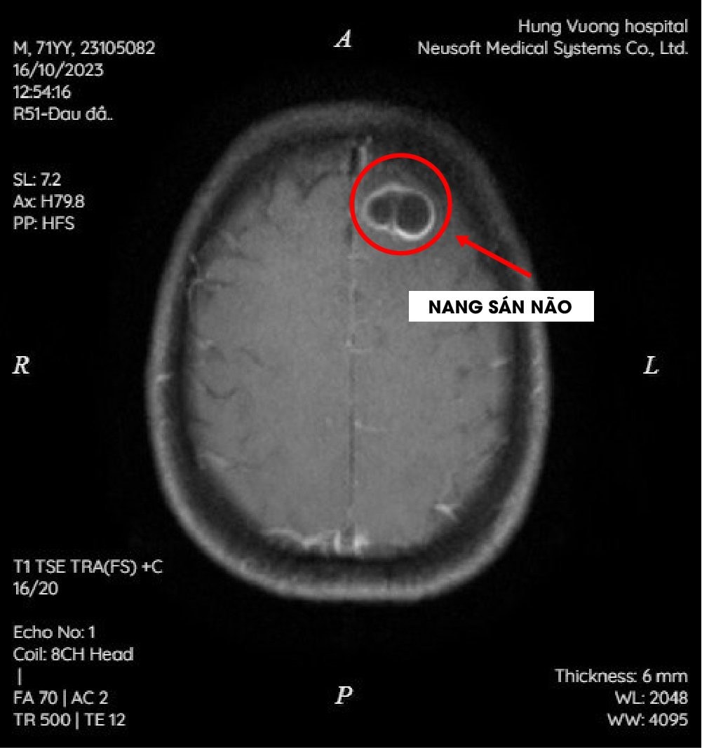 Từ thói quen ăn tiết canh, 2 bệnh nhân nhiễm nang sán trong não -0
