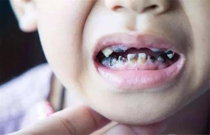 Những dấu hiệu nhận biết sớm giúp ngăn ngừa nguy cơ sâu răng ở trẻ -0