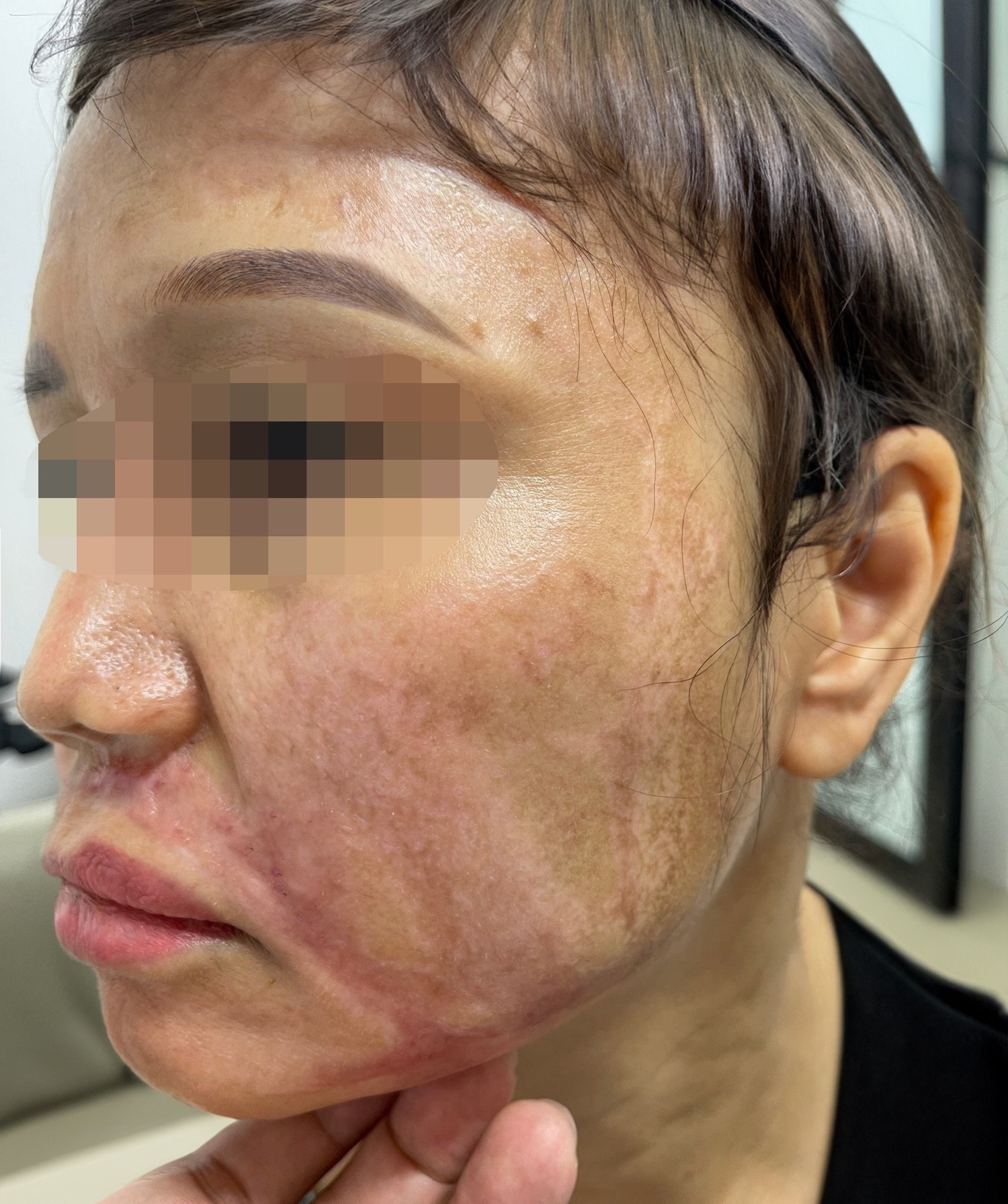 Peel da trị nám, người phụ nữ bị bỏng nặng -0