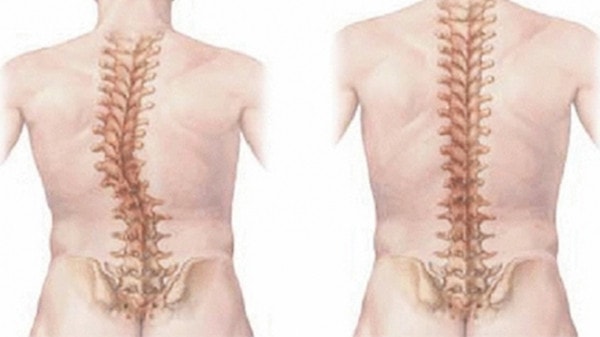 Những dấu hiệu nhận biết giúp điều trị bệnh vẹo cột sống khởi phát sớm -0