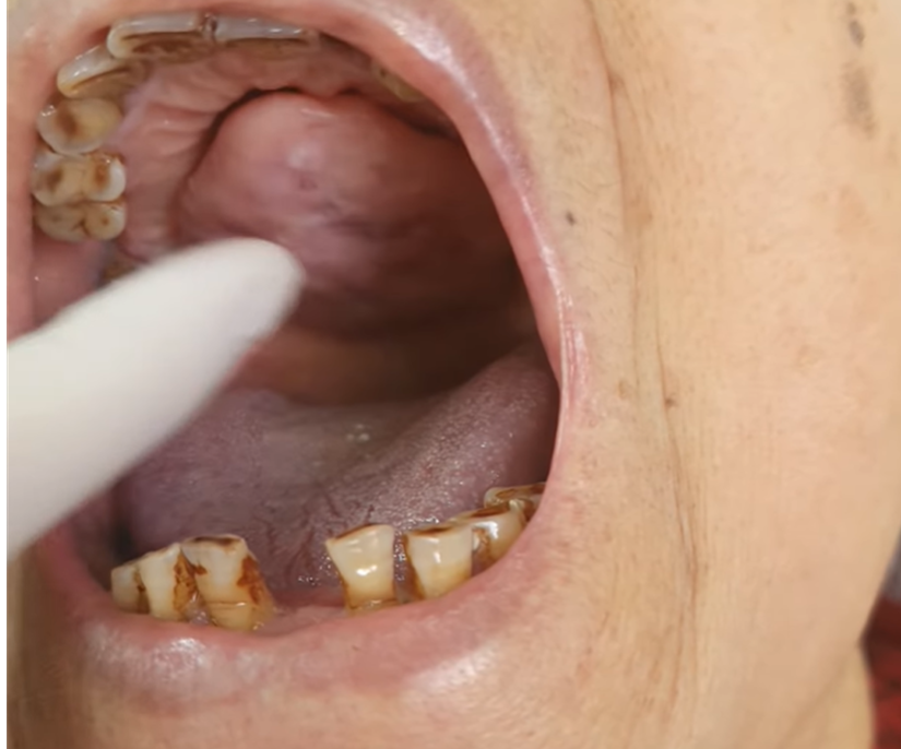10 năm chung sống với khối u lạ hình chiếc đĩa ở vùng vòm miệng -0