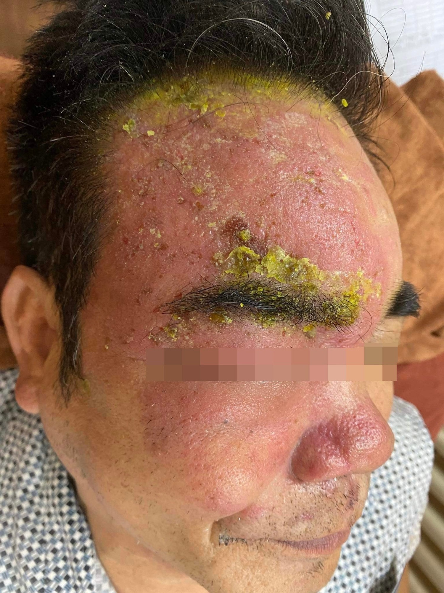 Người đàn ông nguy cơ mù mắt do chữa zona thần kinh sai cách -0