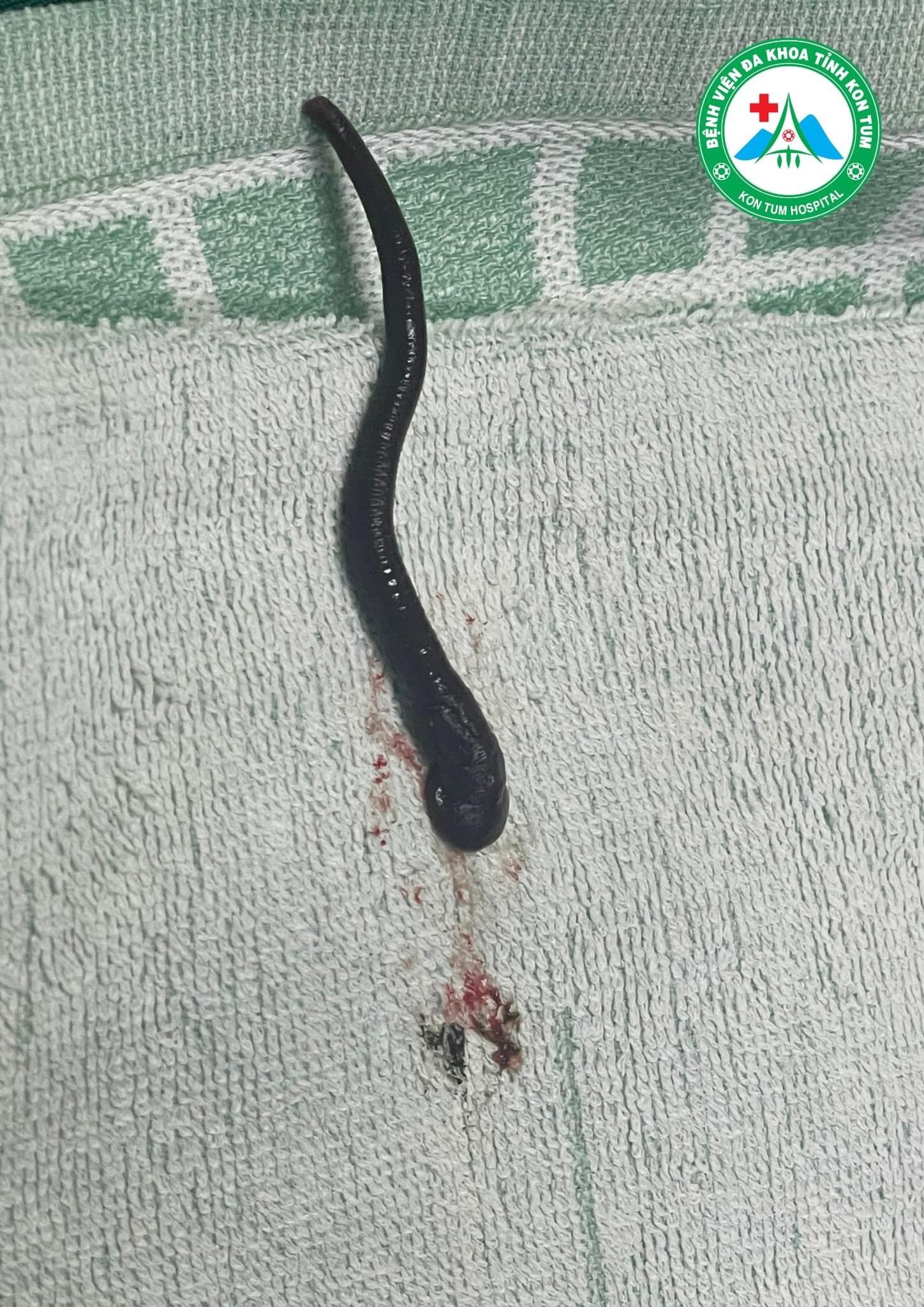 Vắt dài gần 7cm sống trong xoang mũi người phụ nữ -0