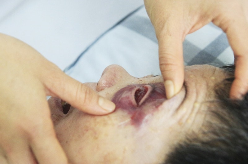 Không may bị ngã, người đàn ông 64 tuổi vỡ nhãn cầu -0