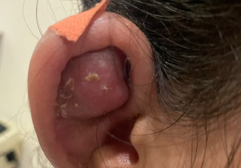 Bác sĩ khuyến cáo, biến chứng nguy hiểm từ xỏ khuyên trên vành tai -0