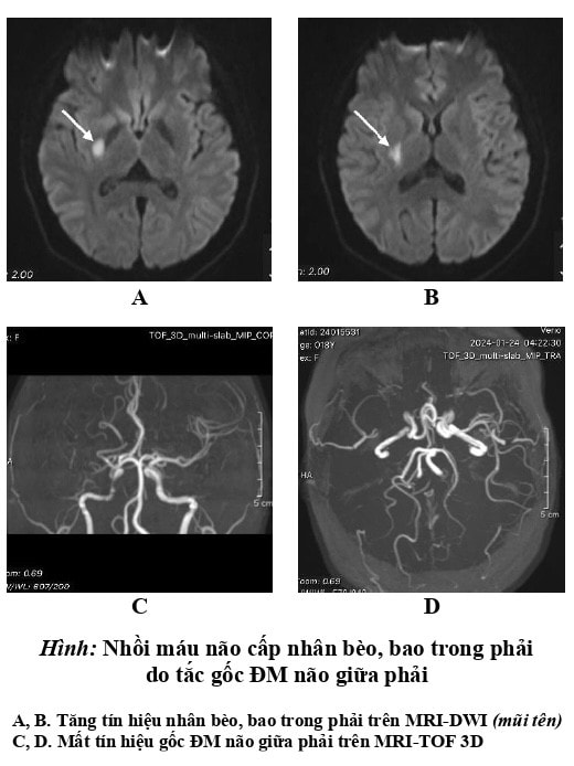 Cứu thành công nữ sinh 18 tuổi bị đột quỵ hiếm gặp -0