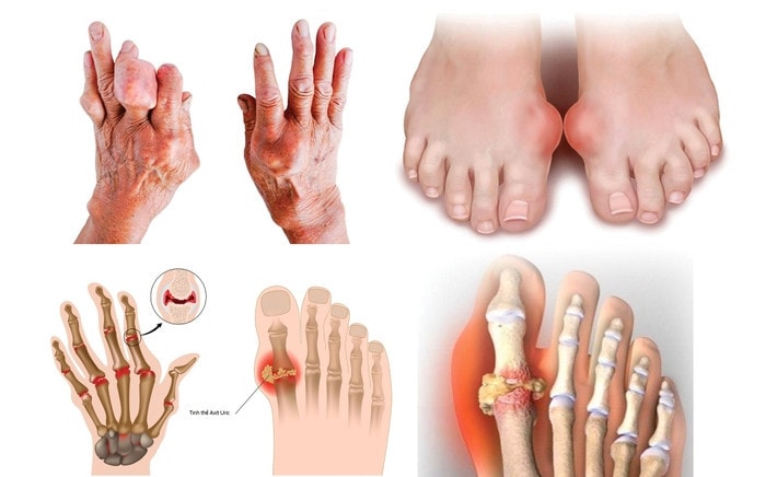 6 thực phẩm cần tránh vào dịp Tết cho người bị bệnh gout -0