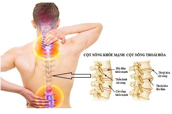 Thoái hóa cột sống thắt lưng ngày càng trẻ hóa, bác sĩ lưu ý cần chủ động phòng tránh -0
