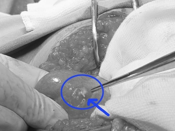 Nuốt phải tăm tre, nam bệnh nhân 19 tuổi thủng ruột -0